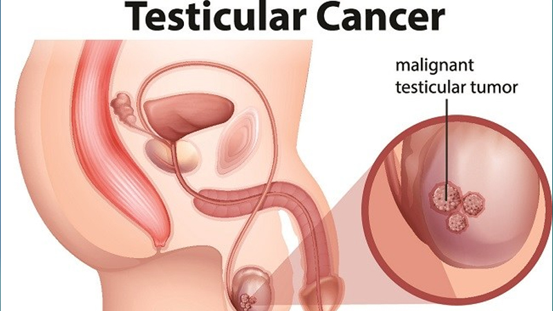 Kanker Testis: Gejala dan Pencegahan dari PAFI Pamenang